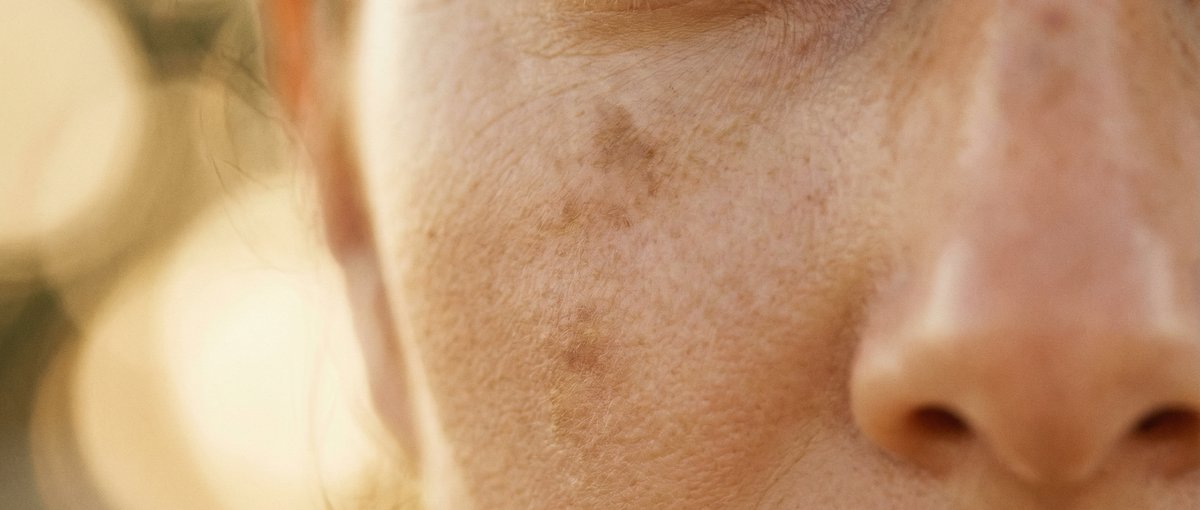 Close-up of a woman's face showing pigmentation spots on the cheek