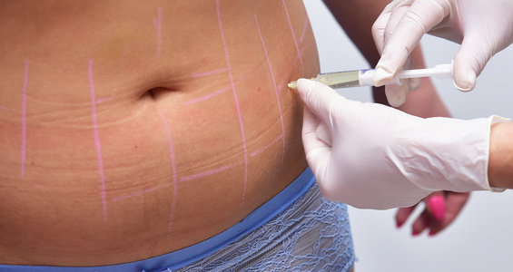 Fat Dissolving Mesotherapy