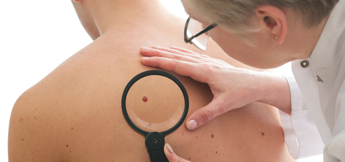 understanding-moles-demystifying-myths-and-recognizing-the-signs-of-skin-health.jpg