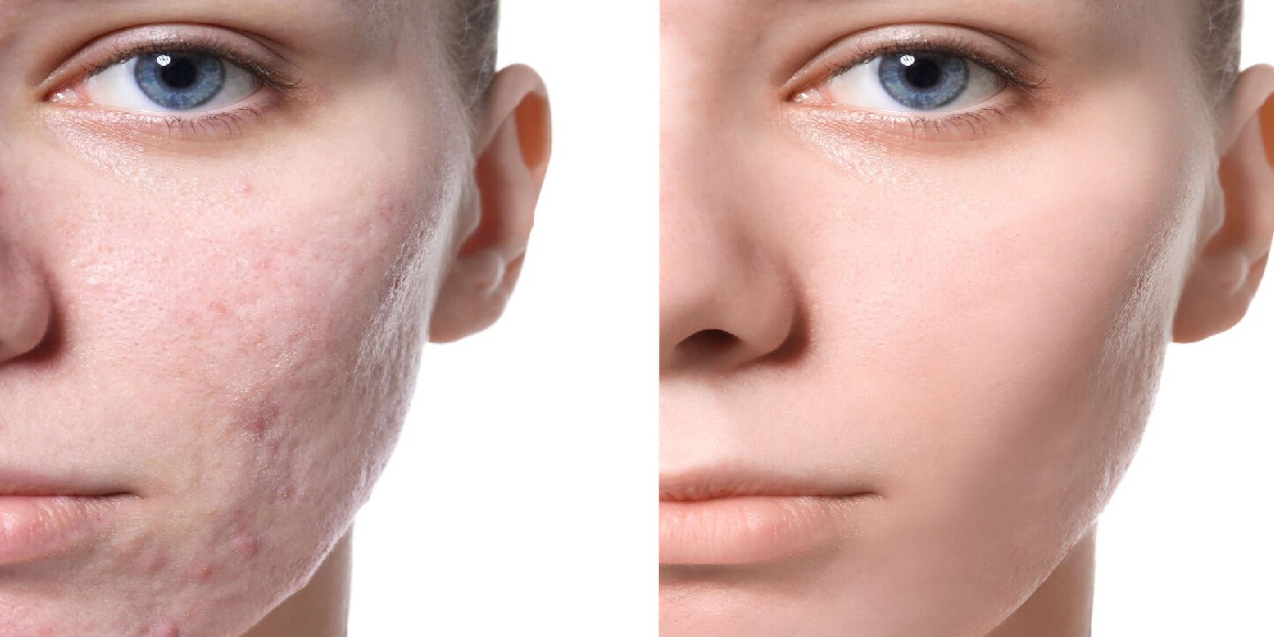 Acne-treatment.jpg