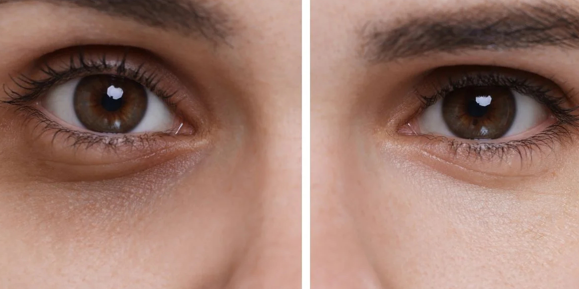 Under-Eye-Dark-Circles.jpg